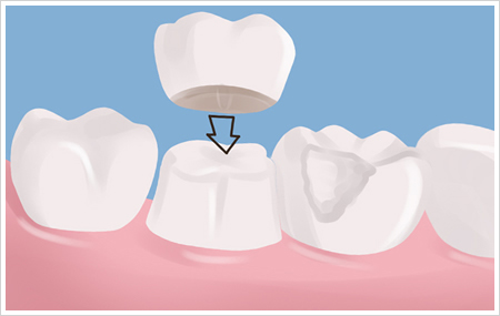 Dental Crowns Purpose, Procedure, Complications | Smile Design Center