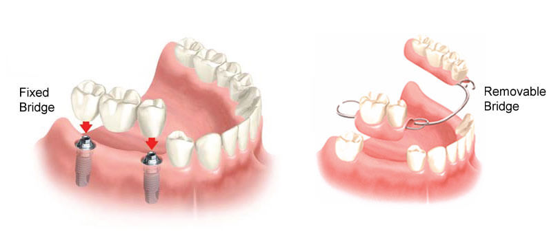 Fixed & Removable Dental Bridges | Smile Design Center of Westchester